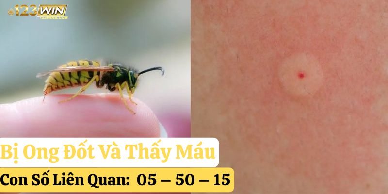 tự nhiên bị ong đốt