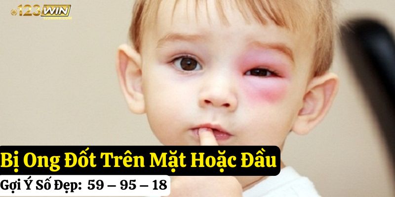 tự nhiên bị ong đốt đánh gì