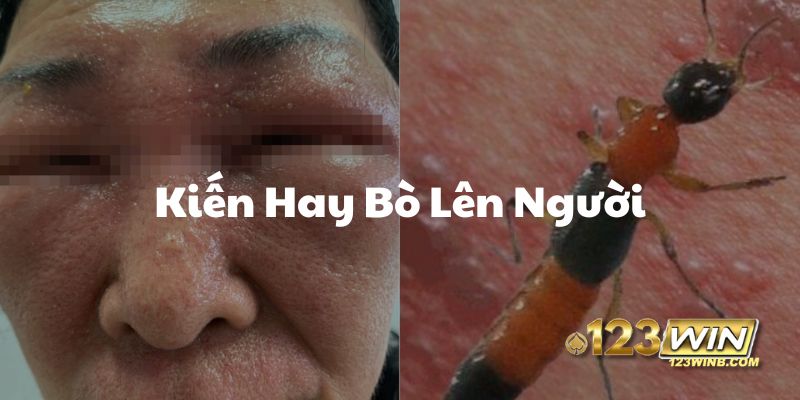 kiến hay bò lên người 123win thumb